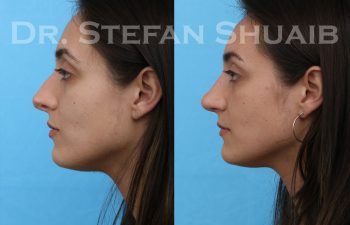 female patient before and after revision rhinoplasty procedure