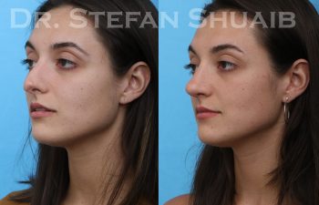 female patient before and after revision rhinoplasty procedure