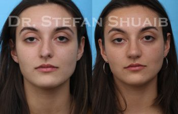 female patient before and after revision rhinoplasty procedure