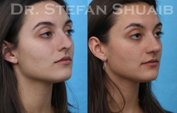 female patient before and after revision rhinoplasty procedure