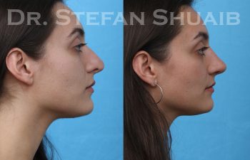 female patient before and after revision rhinoplasty procedure