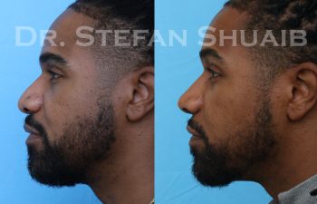 male patient before and after rhinoplasty procedure