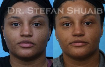 female patient before and after rhinoplasty procedure