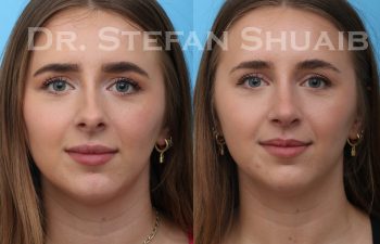 female patient before and after rhinoplasty procedure