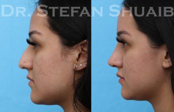 female patient before and after rhinoplasty procedure