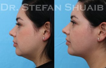 images before and after neck lift procedure