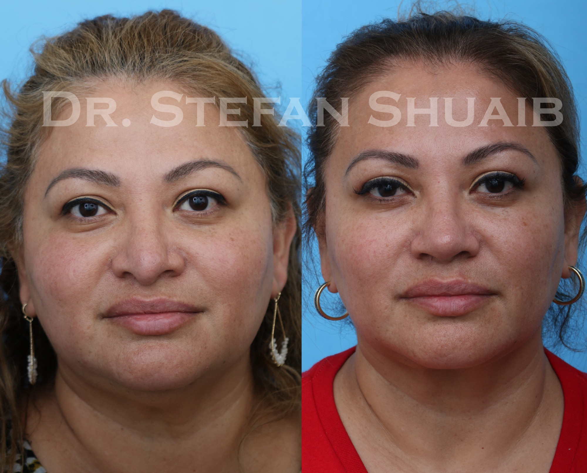 female patient before and after revision rhinoplasty procedure
