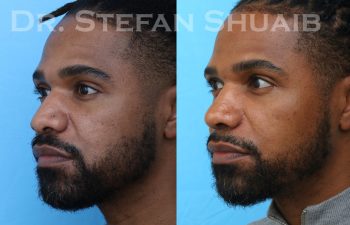 male patient before and after rhinoplasty procedure