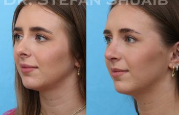 female patient before and after rhinoplasty procedure