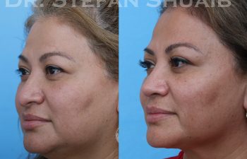 female patient before and after revision rhinoplasty procedure