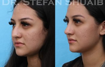 female patient before and after rhinoplasty procedure