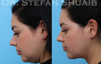images before and after neck lift procedure