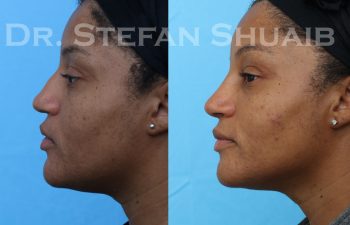 female patient before and after rhinoplasty procedure