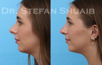 female patient before and after rhinoplasty procedure