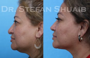 female patient before and after revision rhinoplasty procedure