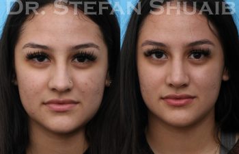 female patient before and after rhinoplasty procedure