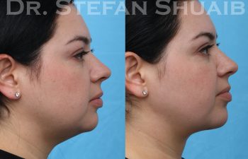 images before and after neck lift procedure