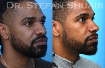 male patient before and after rhinoplasty procedure