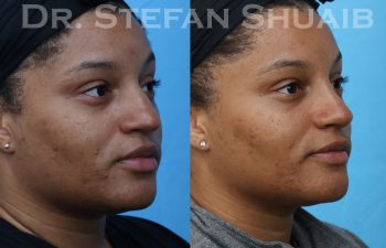 female patient before and after rhinoplasty procedure