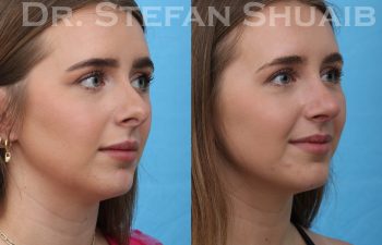 female patient before and after rhinoplasty procedure