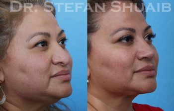 female patient before and after revision rhinoplasty procedure