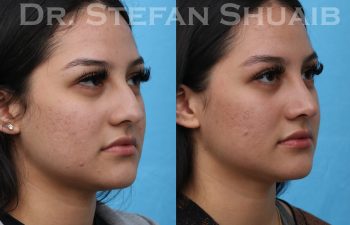 female patient before and after rhinoplasty procedure