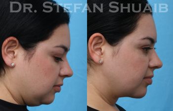 images before and after neck lift procedure