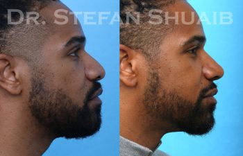 male patient before and after rhinoplasty procedure