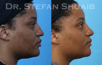 female patient before and after rhinoplasty procedure