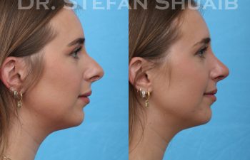 female patient before and after rhinoplasty procedure