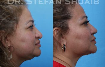 female patient before and after revision rhinoplasty procedure