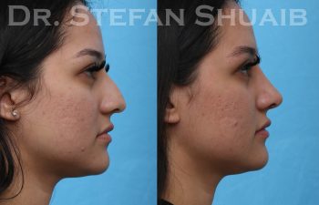 female patient before and after rhinoplasty procedure