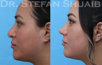 female patient before and after revision rhinoplasty procedure