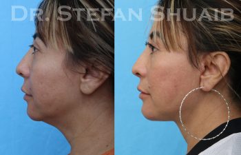 female patient before and after facial rejuvenation procedure
