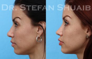 female patient before and after rhinoplasty procedure