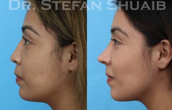 female patient before and after revision rhinoplasty procedure