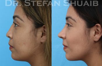 female patient before and after revision rhinoplasty procedure