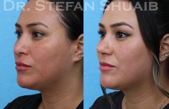 female patient before and after revision rhinoplasty procedure