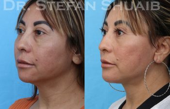 female patient before and after facial rejuvenation procedure