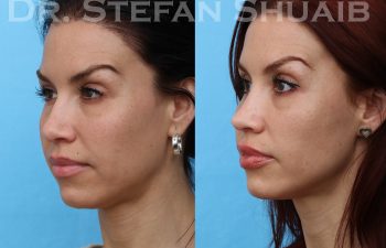 female patient before and after rhinoplasty procedure