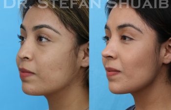 female patient before and after revision rhinoplasty procedure