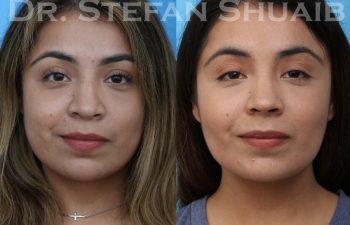 female patient before and after revision rhinoplasty procedure