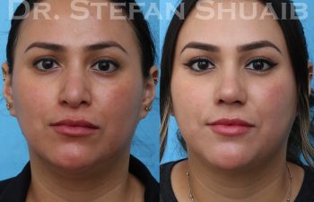 female patient before and after revision rhinoplasty procedure