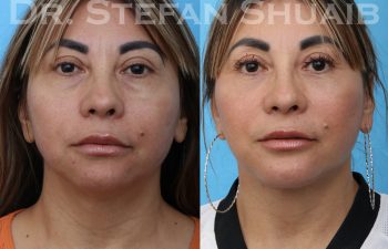 female patient before and after facial rejuvenation procedure