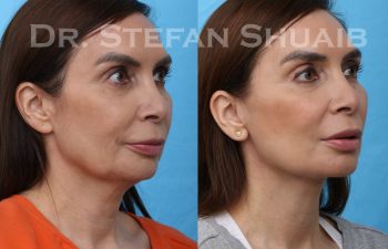 images before and after facial rejuvenation procedure