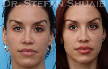 female patient before and after rhinoplasty procedure