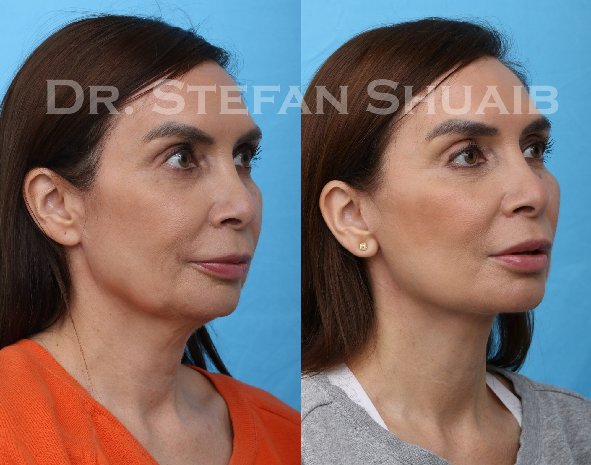 images before and after facial rejuvenation procedure