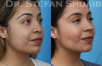 female patient before and after revision rhinoplasty procedure