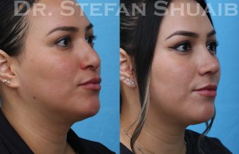 female patient before and after revision rhinoplasty procedure