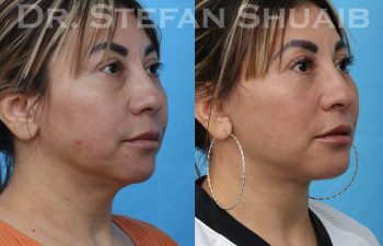 female patient before and after facial rejuvenation procedure